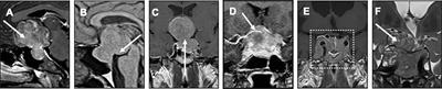 Outcome of giant pituitary tumors requiring surgery